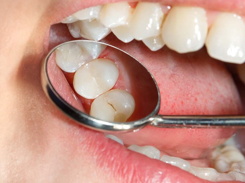 3 دلیل برای اجرای پیمایش سلامت دهان و دندان دانشآموزان