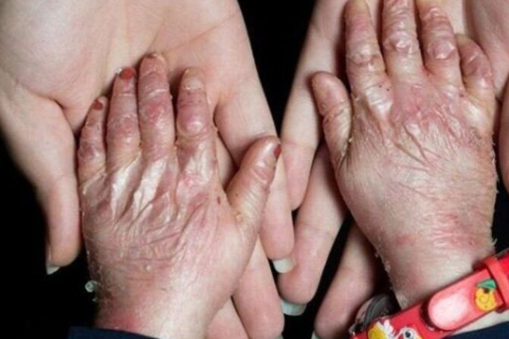 شناسایی 1250 بیمار پروانهای؛ کمبود پانسمان