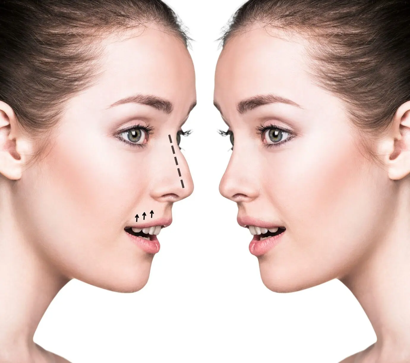 مراحل جراحی بینی: از تصمیمگیری تا روز عمل